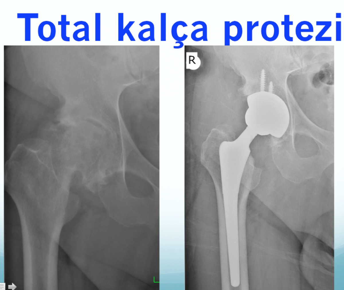 Kalça Kireçlenmesi - Kalça Protezi Ameliyatı