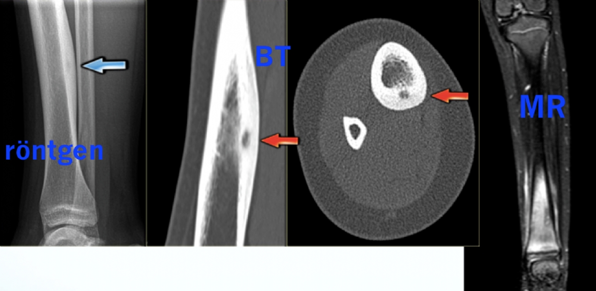 Osteoid Osteoma