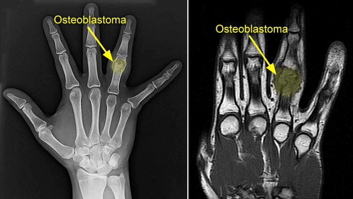 Osteoblastoma