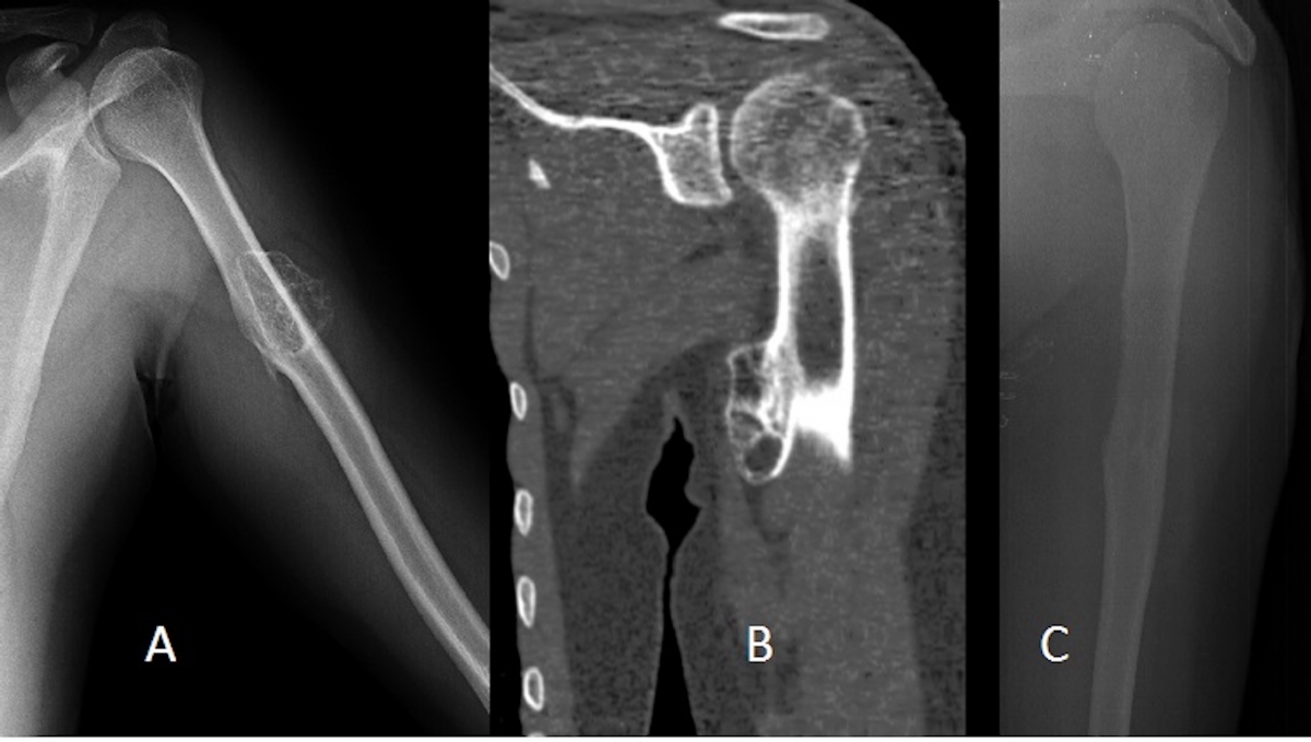 Osteokondroma