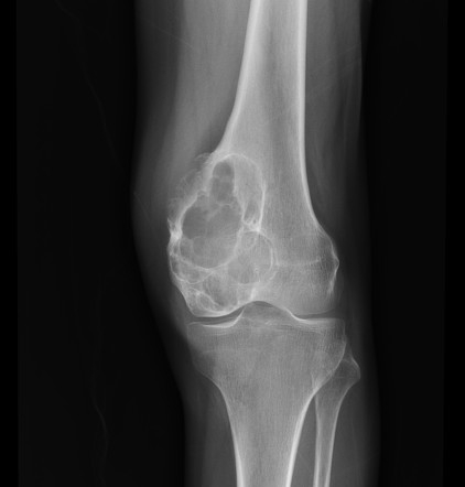 Kondromiksoid Fibroma