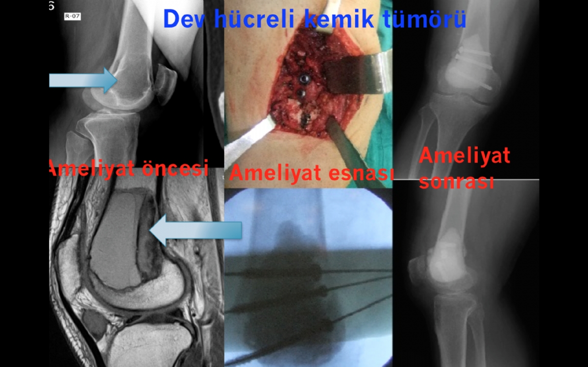 Dev Hücreli Kemik Tümörü