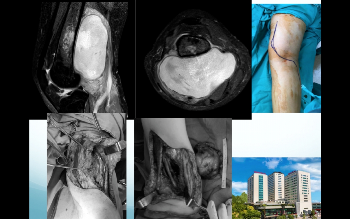 Periferik Sinir Tümörleri ( Schwannoma)