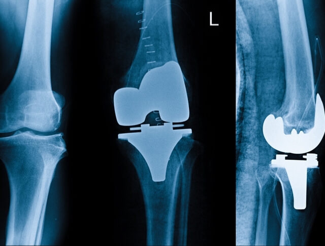 Diz Protezi Ameliyatı