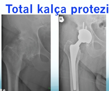 Kalça Protezi Ameliyatı