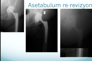 kalça re-revizyonu (asetabulum)