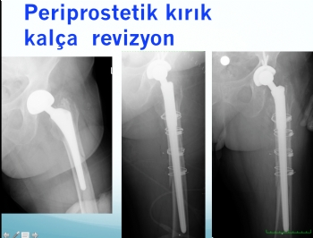 Kalça Protezi Revizyon Ameliyatı