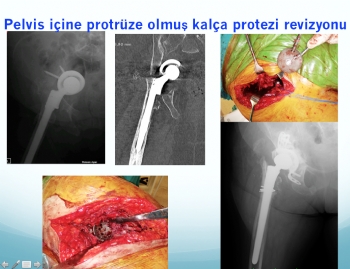 kalça re-revizyonu (asetabulum)