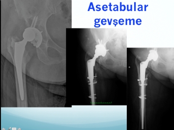 kalça protezi tek aşamalı revizyon 