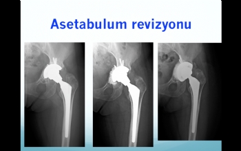 asetabulum revizyonu