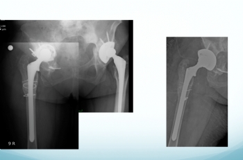 Kalça Protezi Revizyon Ameliyatı