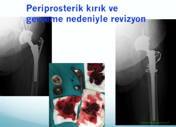 periprostetik femur kıırığı ve aseptik gevşeme 