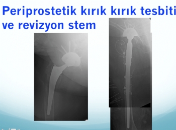 periprostetik femur kıırığı 