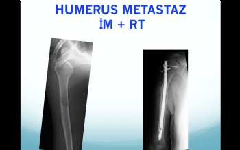 humerus mestataz