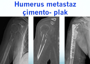 humerus mestataz