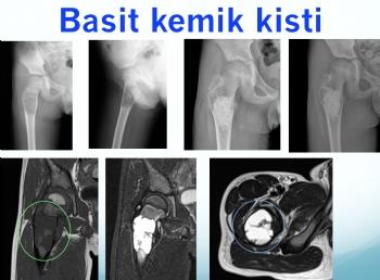 femur basit kemik kisti, femur simple bone cyst
