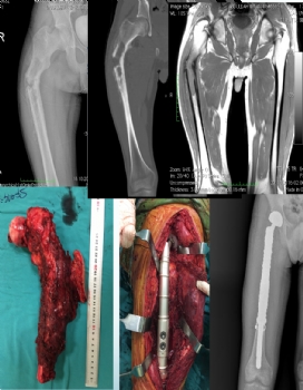 femur proksimal metastaz 