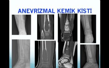 tibia anevrizmal kemik kisti