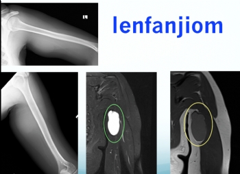 KOLDA LENFANJİOM