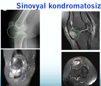 sinovyal kondromatozis