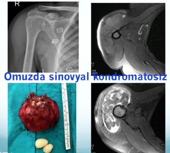 omuz sinovyal kondromatosiz , shoulder synovial chondromatosis