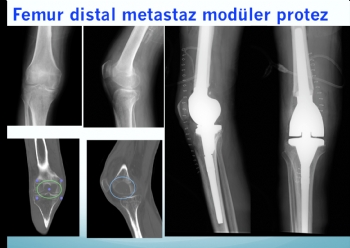 femur distal metastaz modüler protez 