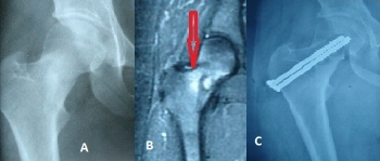 osteoid osteoma 