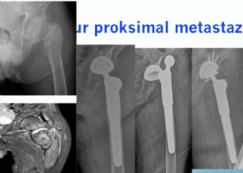 femur proksimal metastaz klitli asetabuler cup 