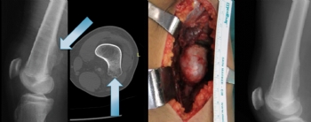 femur osteokondrom (eksositoz )