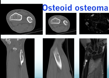 ulna osteoid osteoma 