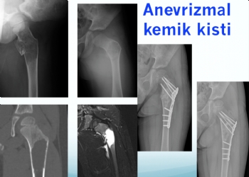 femur anevrizmal kemik kisti, 