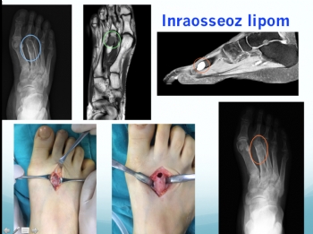 metatars içi lipom, intraosseous lipoma