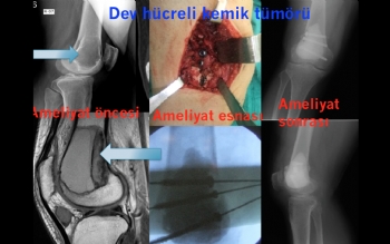 Tümör Ameliyatları