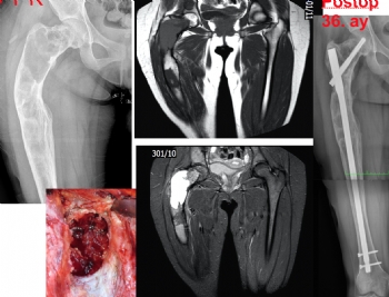 femur fibrözdisplazi osteotomi ve intramedüller çivi ile tespit 