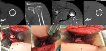osteoid osteoma humerus 