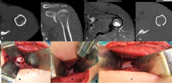 osteoid osteoma humerus 