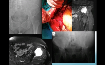 femur proksimal metastaz 