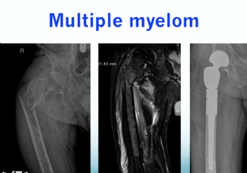 FEMUR PROKSİMAL MULTİPLE MİYELOM MODÜLER PROTEZ