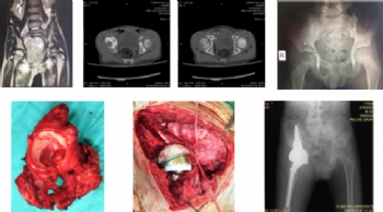 Asetabulum yerleşimli Ewing Sarkoma
