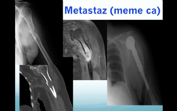 HUMERUS METASTAZ 