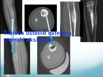 tibia osteoid osteoma 