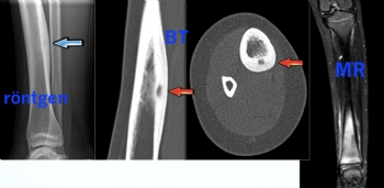 tibia osteoid osteoma 