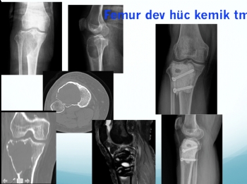 femur dev hücreli kemik tümörü, femur giant cell bone tumor, curetaj nitrogen and bone cement 