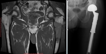 femur proksimal metastaz modüler protez ile rekonstrüksiyon