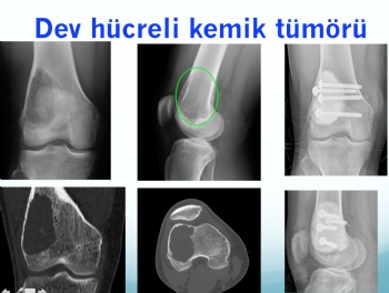 femur dev hücreli kemik tümörü, femur giant cell bone tumor, curetaj nitrogen and bone cement 