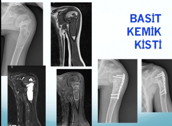 humerus basit kemik kisti, humerus simple bone cyst