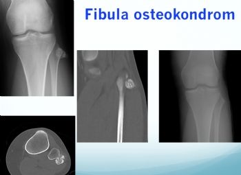 fibula osteokondrom