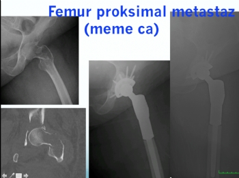 KALÇA BÖLGESİ METASTAZ PROTEZ UYGULAMASI