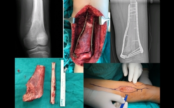 femur distal ewing sarkom biyolojik rekonstrüksiyon 