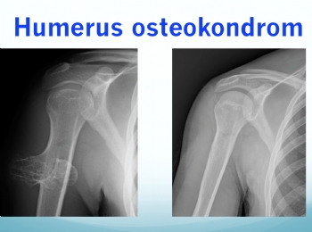 humerus osteokondrom